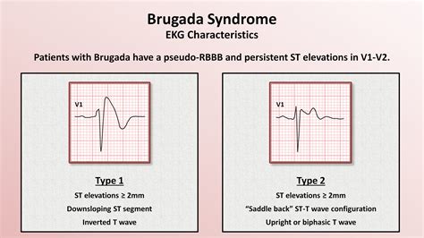 sindrome de chanel|Brugada syndrome .